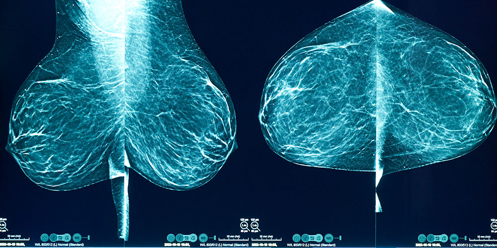 immagini 2D esame mammografia