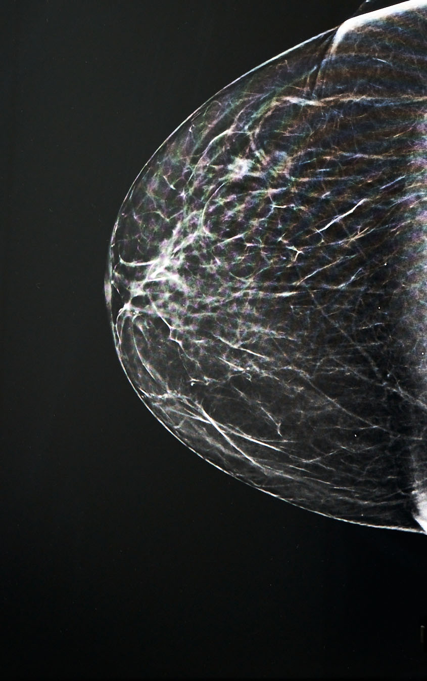 screening mammografico - dettaglio formazione seno