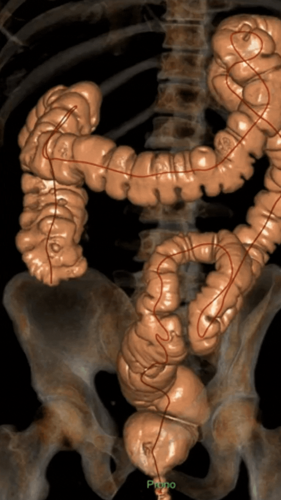 colonscopia virtuale - vista colon