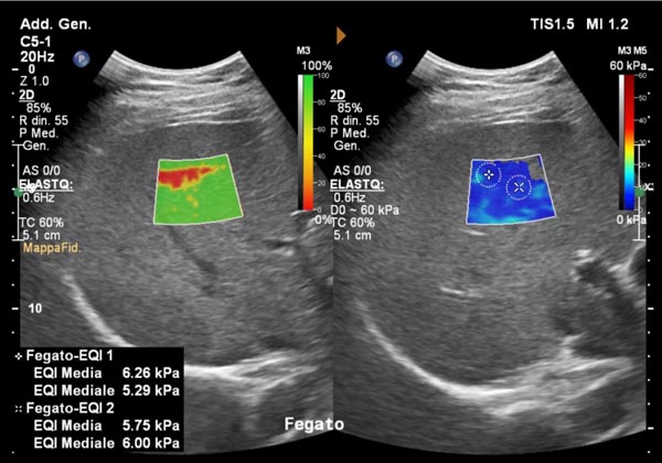 immagine esame elastosonografia epatica