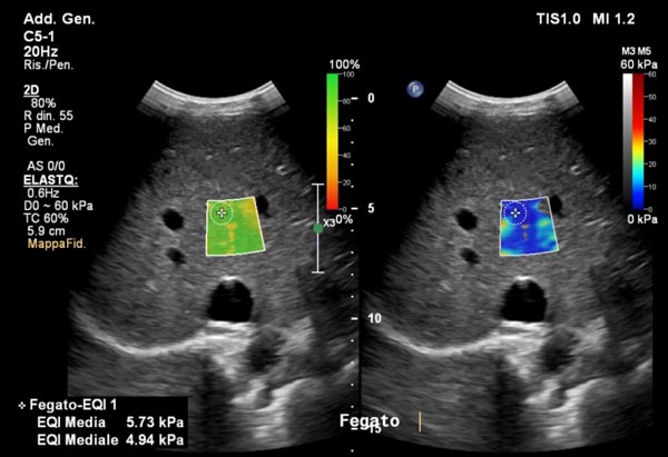 immagine esame elastosonografia epatica