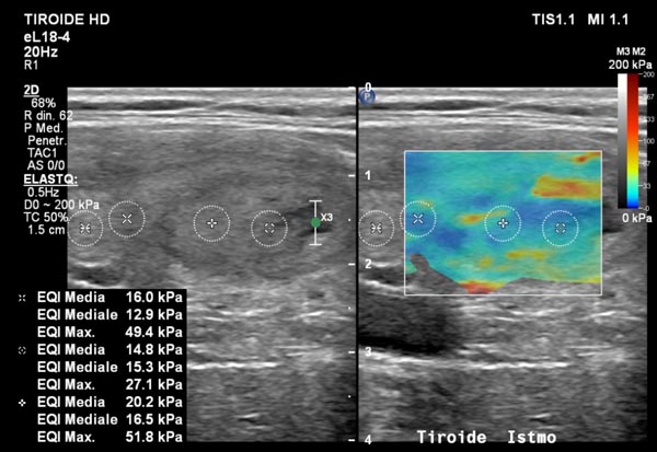 immagine esame elastosonografia tiroidea