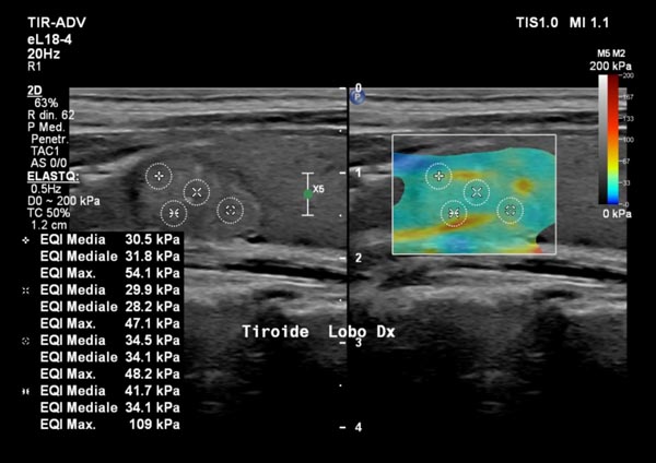 immagine esame elastosonografia tiroidea