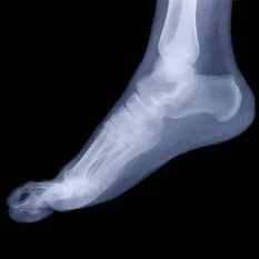 radiologia digitale piede