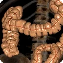 Colonscopia