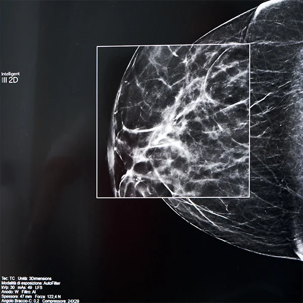 screening mammografico dettaglio tumore