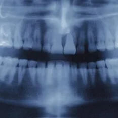 radiologia digitale bocca