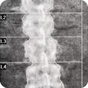 dexa